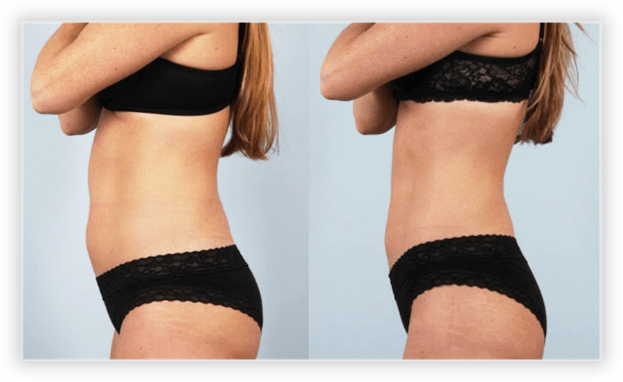 Non Surgical Facelift 2